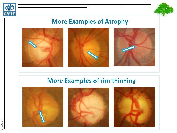 More Examples of Atrophy IIIT Hyderabad More Examples of rim thinning 