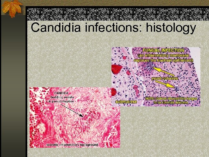 Candidia infections: histology 