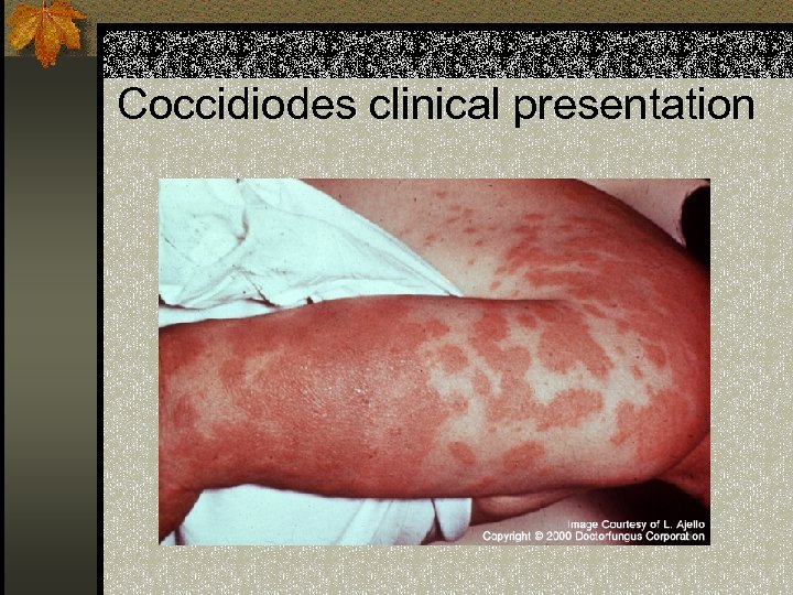 Coccidiodes clinical presentation 