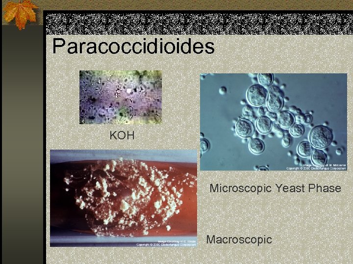 Paracoccidioides KOH Microscopic Yeast Phase Macroscopic 