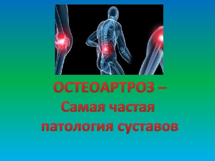 ОСТЕОАРТРОЗ – Самая частая патология суставов 