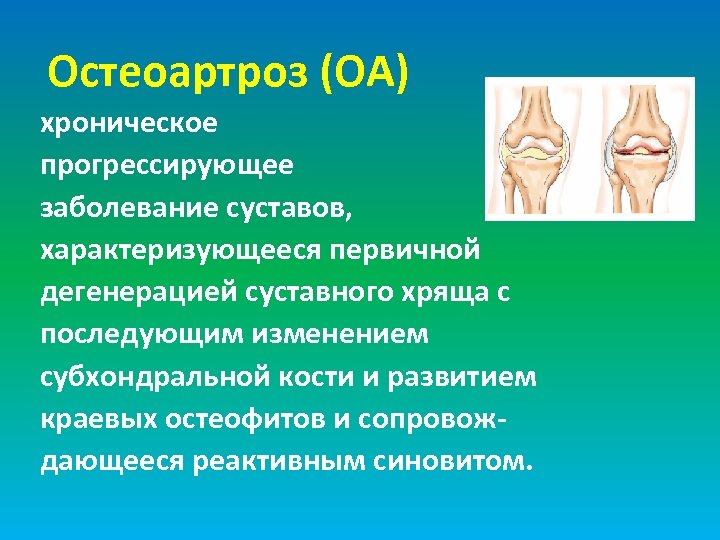 Остеоартроз (ОА) хроническое прогрессирующее заболевание суставов, характеризующееся первичной дегенерацией суставного хряща с последующим изменением
