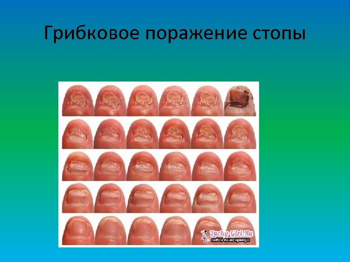 Грибковое поражение стопы 