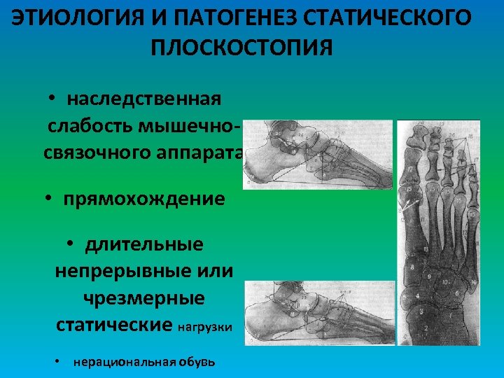 ЭТИОЛОГИЯ И ПАТОГЕНЕЗ СТАТИЧЕСКОГО ПЛОСКОСТОПИЯ • наследственная слабость мышечносвязочного аппарата • прямохождение • длительные