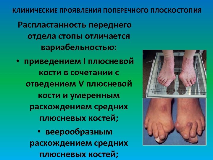 КЛИНИЧЕСКИЕ ПРОЯВЛЕНИЯ ПОПЕРЕЧНОГО ПЛОСКОСТОПИЯ Распластанность переднего отдела стопы отличается вариабельностью: • приведением I плюсневой