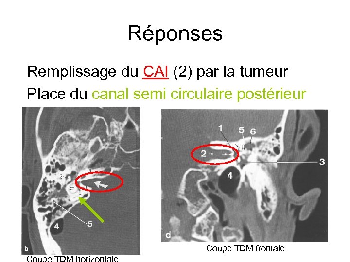Réponses Remplissage du CAI (2) par la tumeur Place du canal semi circulaire postérieur