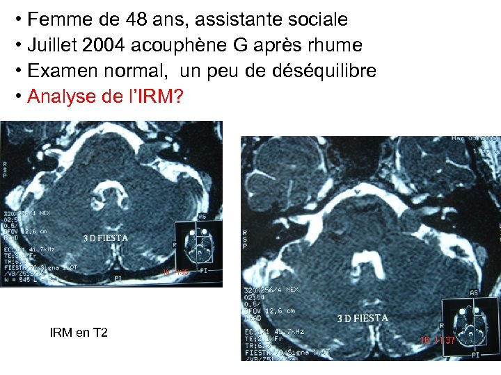  • Femme de 48 ans, assistante sociale • Juillet 2004 acouphène G après