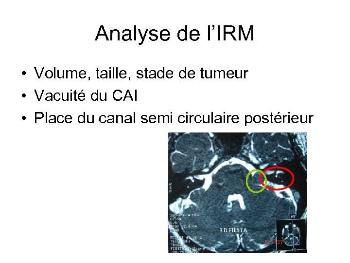 Analyse de l’IRM • Volume, taille, stade de tumeur • Vacuité du CAI •