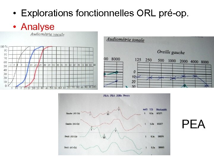  • Explorations fonctionnelles ORL pré-op. • Analyse PEA 