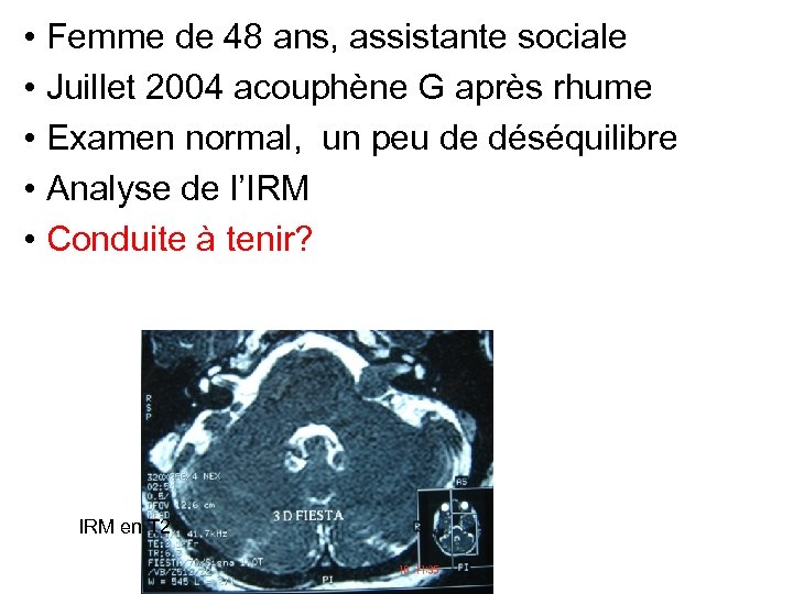  • Femme de 48 ans, assistante sociale • Juillet 2004 acouphène G après