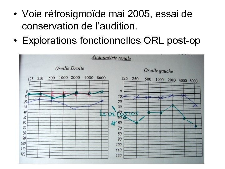  • Voie rétrosigmoïde mai 2005, essai de conservation de l’audition. • Explorations fonctionnelles