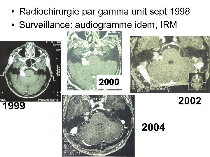  • Radiochirurgie par gamma unit sept 1998 • Surveillance: audiogramme idem, IRM 2000