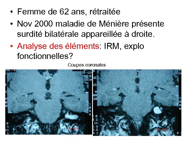  • Femme de 62 ans, rétraitée • Nov 2000 maladie de Ménière présente