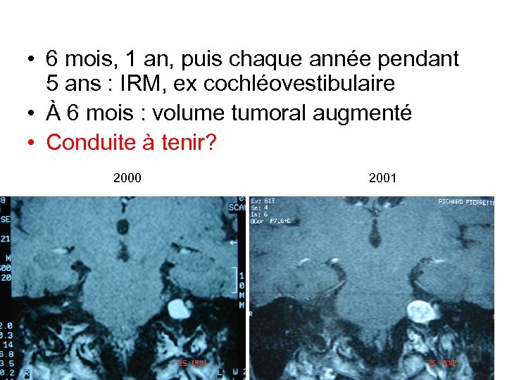  • 6 mois, 1 an, puis chaque année pendant 5 ans : IRM,