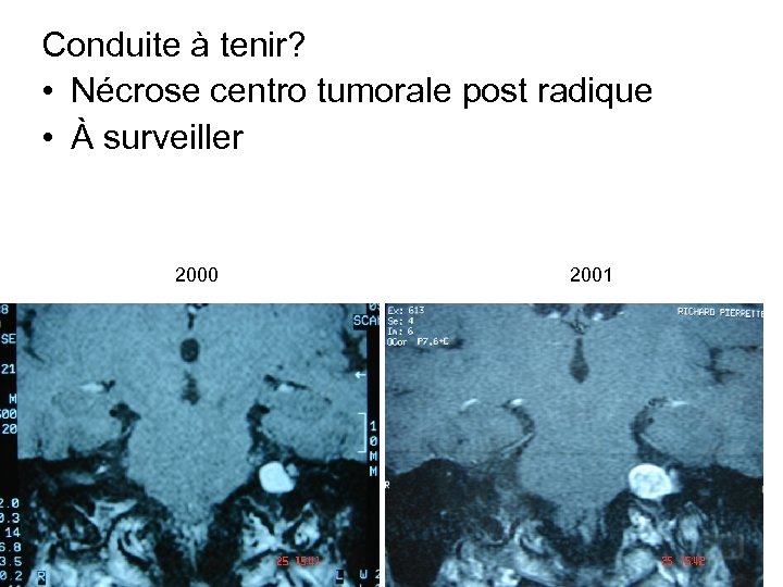 Conduite à tenir? • Nécrose centro tumorale post radique • À surveiller 2000 2001