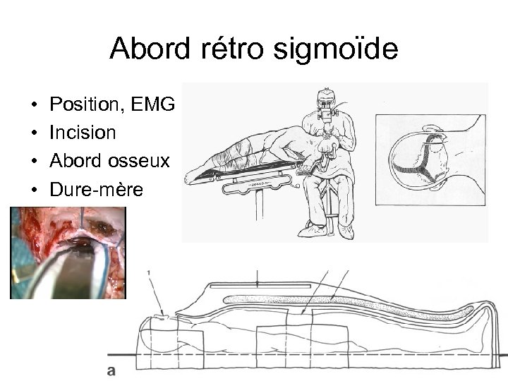Abord rétro sigmoïde • • Position, EMG Incision Abord osseux Dure-mère 