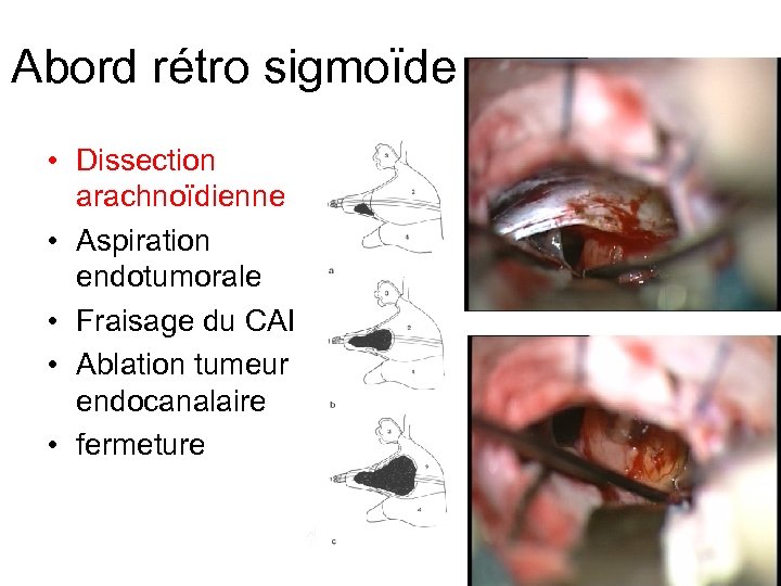 Abord rétro sigmoïde • Dissection arachnoïdienne • Aspiration endotumorale • Fraisage du CAI •