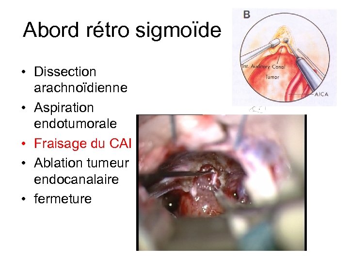 Abord rétro sigmoïde • Dissection arachnoïdienne • Aspiration endotumorale • Fraisage du CAI •
