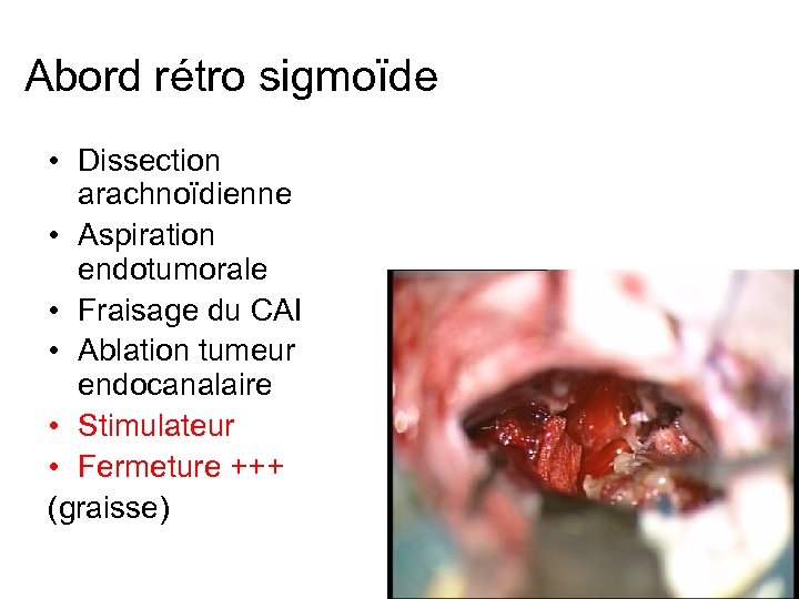 Abord rétro sigmoïde • Dissection arachnoïdienne • Aspiration endotumorale • Fraisage du CAI •