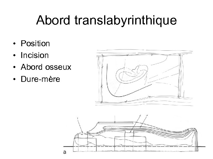Abord translabyrinthique • • Position Incision Abord osseux Dure-mère 