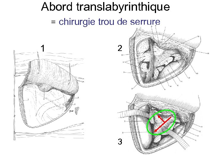 Abord translabyrinthique = chirurgie trou de serrure 1 2 3 