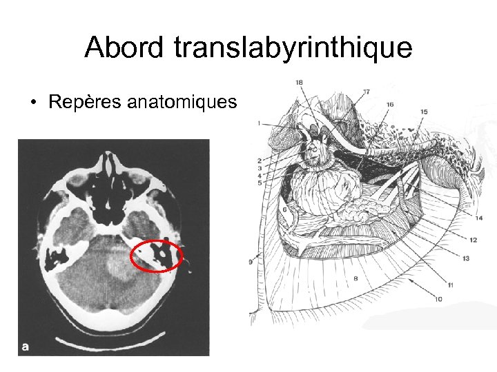 Abord translabyrinthique • Repères anatomiques 