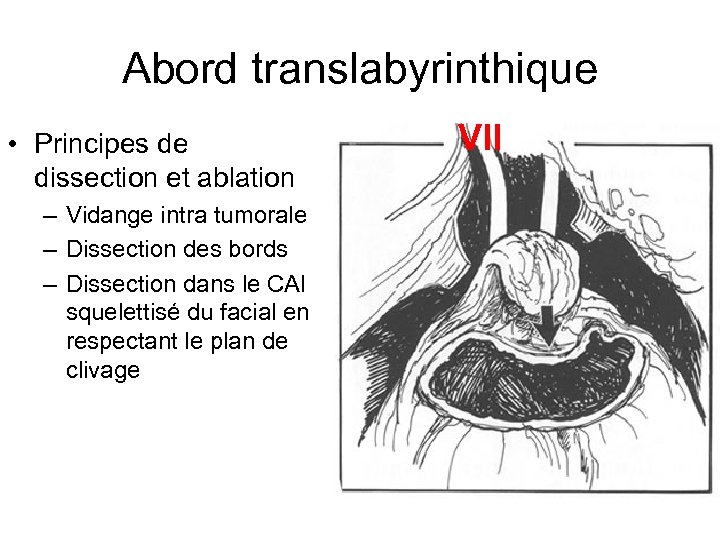 Abord translabyrinthique • Principes de dissection et ablation – Vidange intra tumorale – Dissection