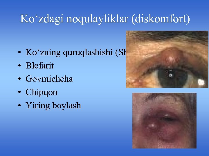 Ko‘zdagi noqulayliklar (diskomfort) • • • Ko‘zning quruqlashishi (Shegren sindromi) Blefarit Govmichcha Chipqon Yiring