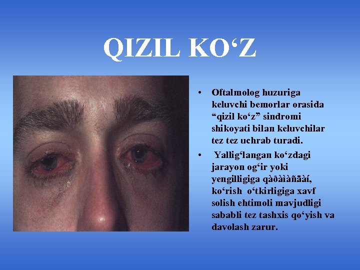 QIZIL KO‘Z • Oftalmolog huzuriga keluvchi bemorlar orasida “qizil ko‘z” sindromi shikoyati bilan keluvchilar