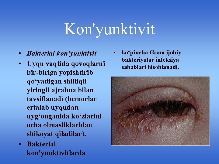 Kon'yunktivit • Bakterial kon'yunktivit • Uyqu vaqtida qovoqlarni bir-biriga yopishtirib qo‘yadigan shilliqliyiringli ajralma bilan