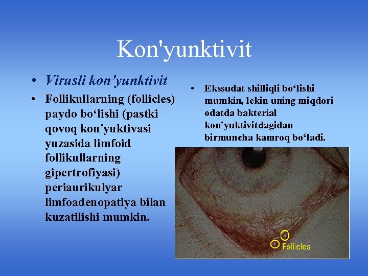 Kon'yunktivit • Virusli kon'yunktivit • Follikullarning (follicles) paydo bo‘lishi (pastki qovoq kon'yuktivasi yuzasida limfoid