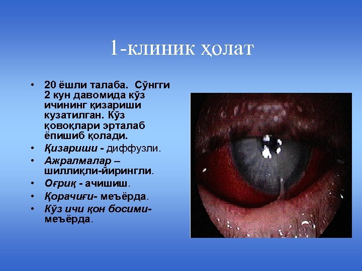 1 -клиник ҳолат • 20 ёшли талаба. Сўнгги 2 кун давомида кўз ичининг қизариши