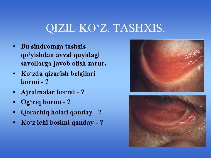 QIZIL KO‘Z. TASHXIS. • Bu sindromga tashxis qo‘yishdan avval quyidagi savollarga javob olish zarur.