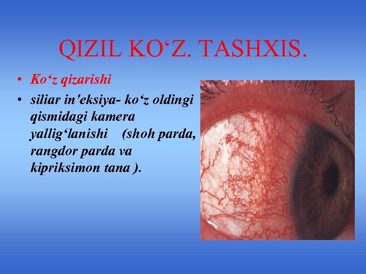 QIZIL KO‘Z. TASHXIS. • Ko‘z qizarishi • siliar in'eksiya- ko‘z oldingi qismidagi kamera yallig‘lanishi
