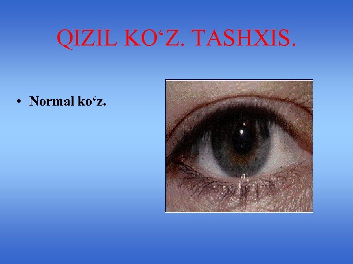 QIZIL KO‘Z. TASHXIS. • Normal ko‘z. 