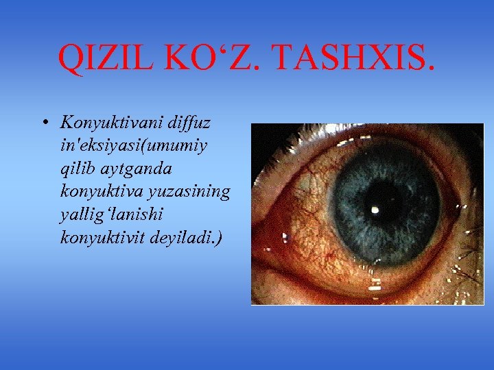QIZIL KO‘Z. TASHXIS. • Konyuktivani diffuz in'eksiyasi(umumiy qilib aytganda konyuktiva yuzasining yallig‘lanishi konyuktivit deyiladi.