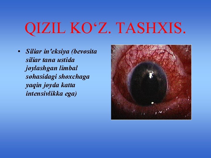 QIZIL KO‘Z. TASHXIS. • Siliar in'eksiya (bevosita siliar tana ustida joylashgan limbal sohasidagi shoxchaga