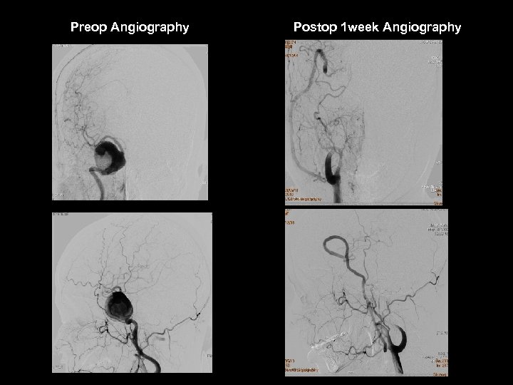 Preop Angiography Postop 1 week Angiography 