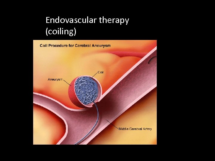 Endovascular therapy (coiling) 