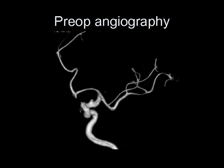 Preop angiography 