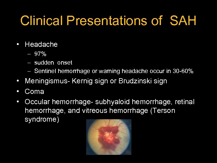 Clinical Presentations of SAH • Headache – 97% – sudden onset – Sentinel hemorrhage