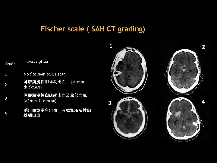 Fischer scale ( SAH CT grading) Grade Description 1 No clot seen on CT