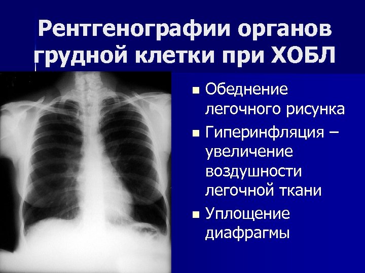 Рентгенографии органов грудной клетки при ХОБЛ Обеднение легочного рисунка n Гиперинфляция – увеличение воздушности