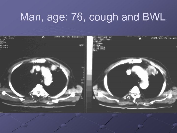 Man, age: 76, cough and BWL 