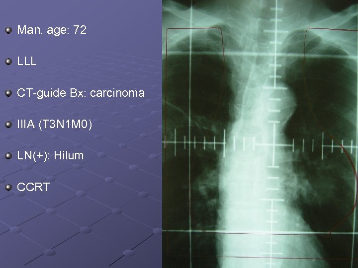 Man, age: 72 LLL CT guide Bx: carcinoma IIIA (T 3 N 1 M