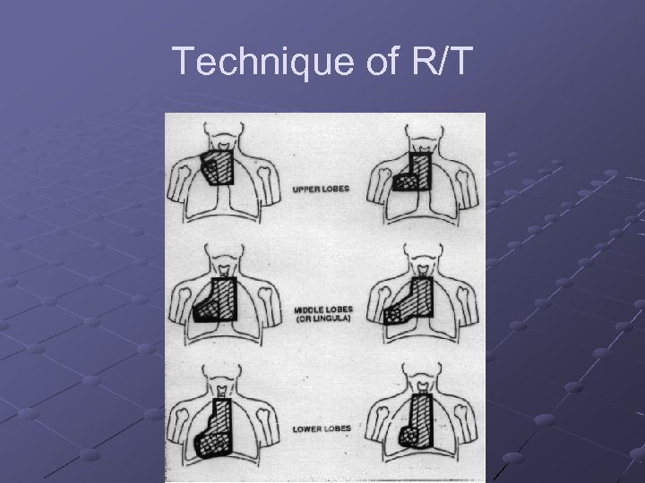 Technique of R/T 