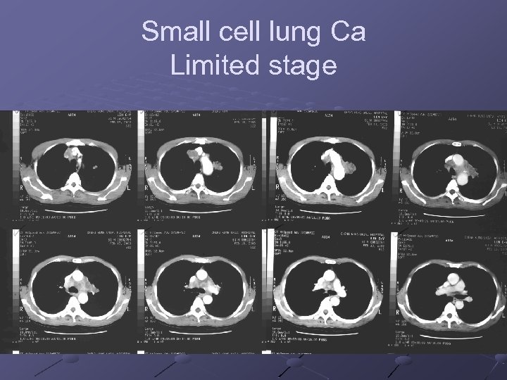 Small cell lung Ca Limited stage 