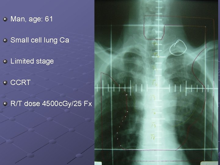 Man, age: 61 Small cell lung Ca Limited stage CCRT R/T dose 4500 c.