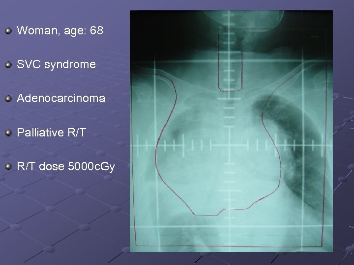 Woman, age: 68 SVC syndrome Adenocarcinoma Palliative R/T dose 5000 c. Gy 