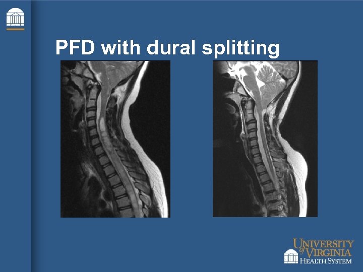 PFD with dural splitting 